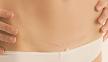 Cirurgia de Reparação de Cicatriz