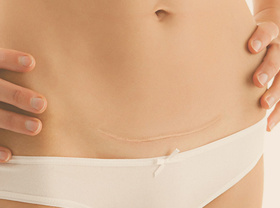 Cirurgia de Reparação de Cicatriz